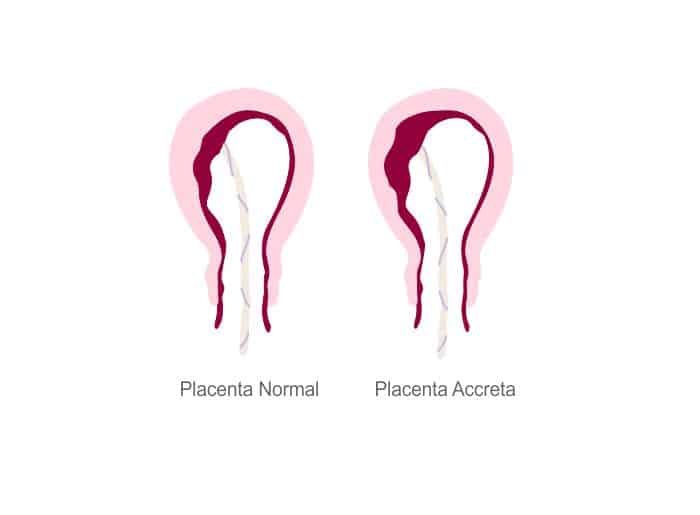 Placenta accreta