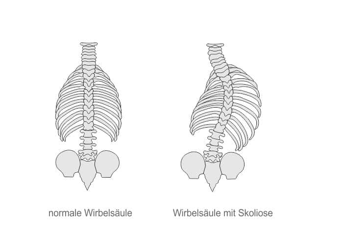 Skoliose